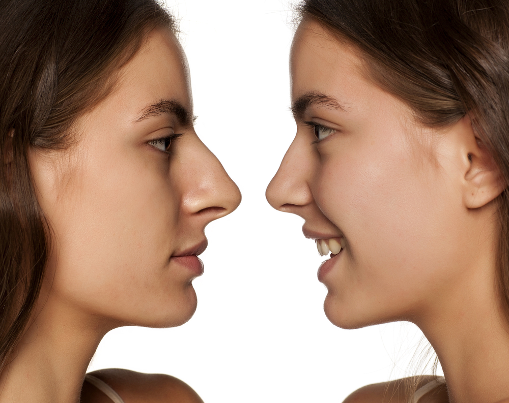Conditions That Can Be Treated with Rhinoplasty