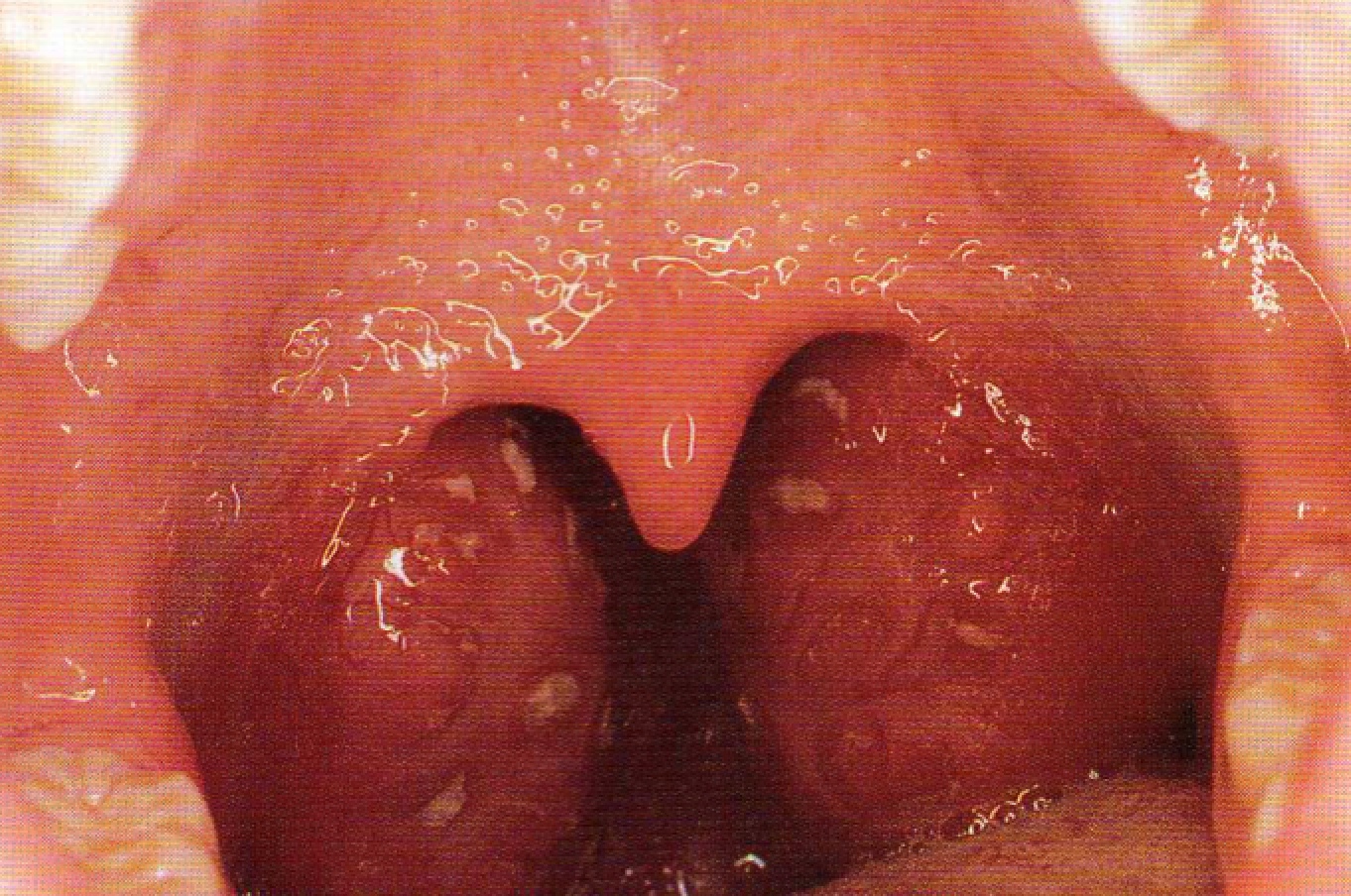 What Happens During A Tonsillectomy?