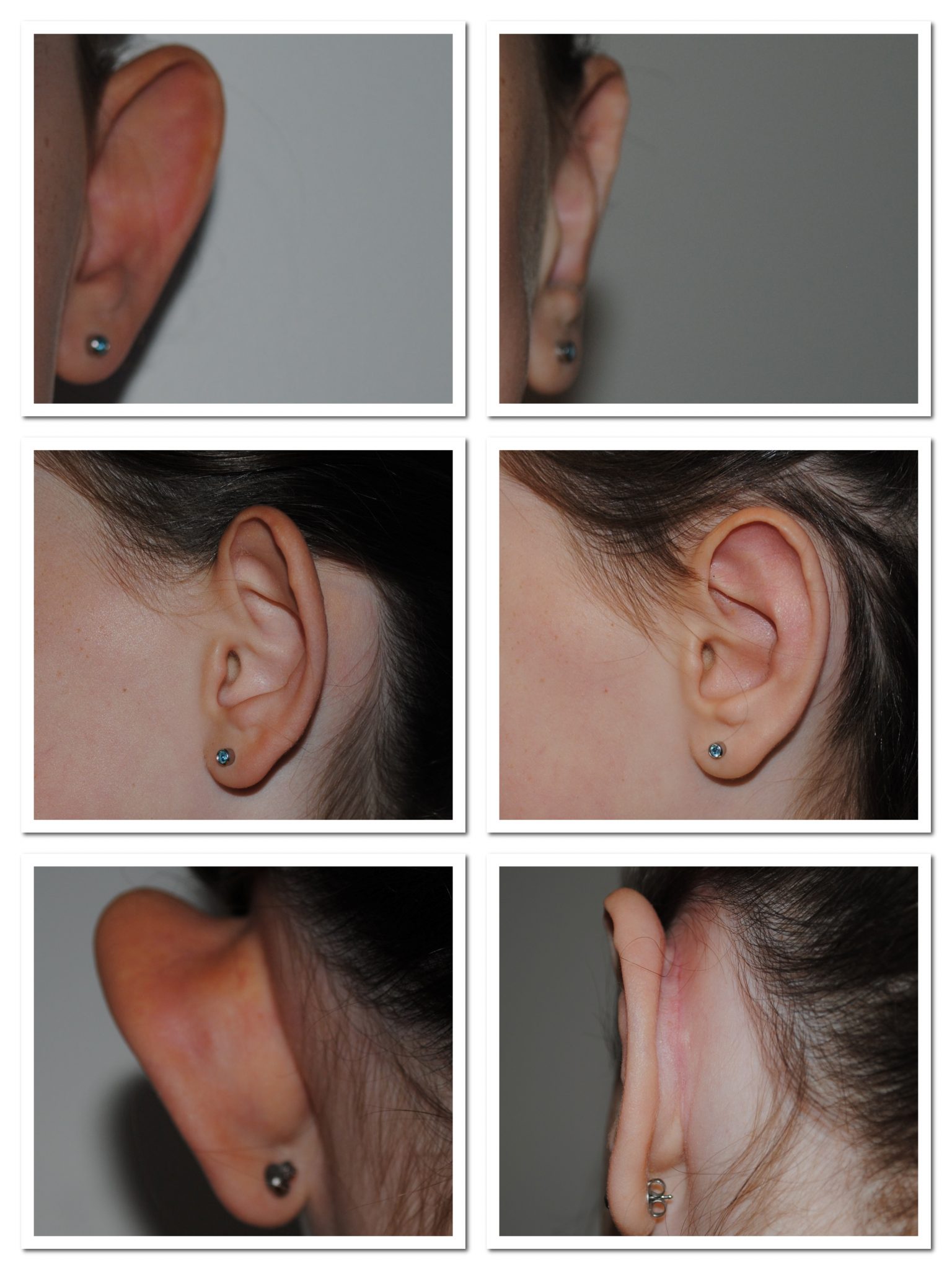 Bat ear correction sale